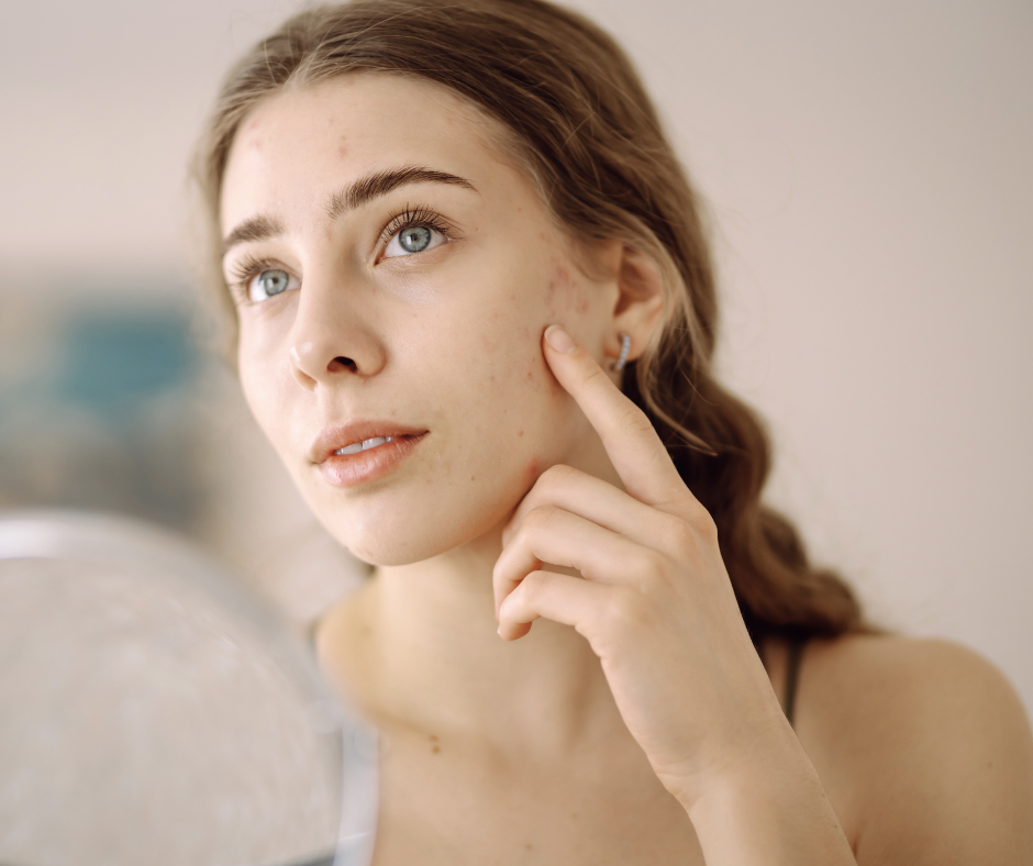 What’s Really Causing Your Acne?