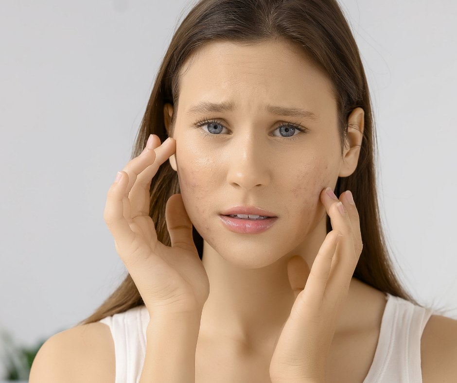Why Teens Struggle More With Acne (And Why It’s Not Their Fault)