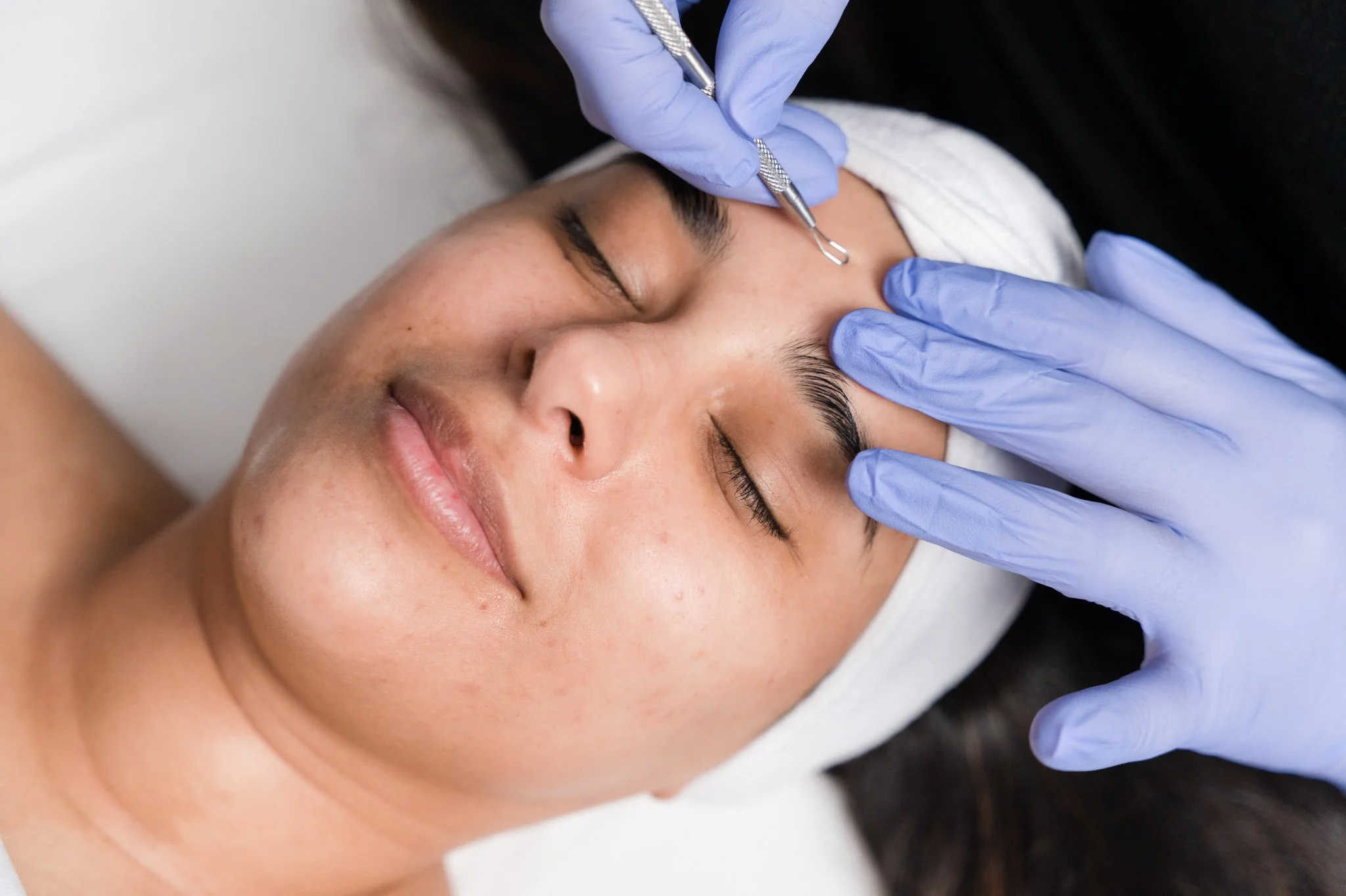How Our 12-Week Acne Program Works