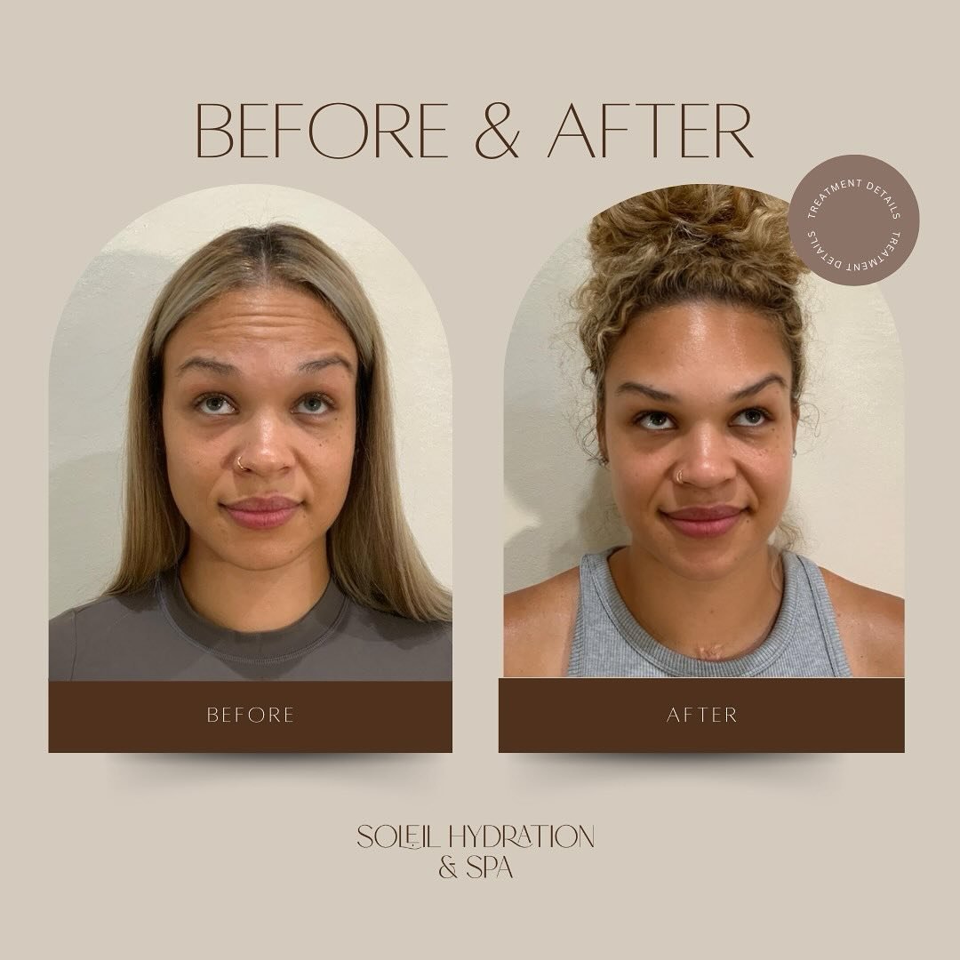 SWIPE ⬅️

This is what we mean by glowing skin 🤩 Daxxify was used to smooth and brighten this beautiful client&rsquo;s skin! 

#daxxify #botox #medspa #aesthetics #atlanta #aestheticinjector