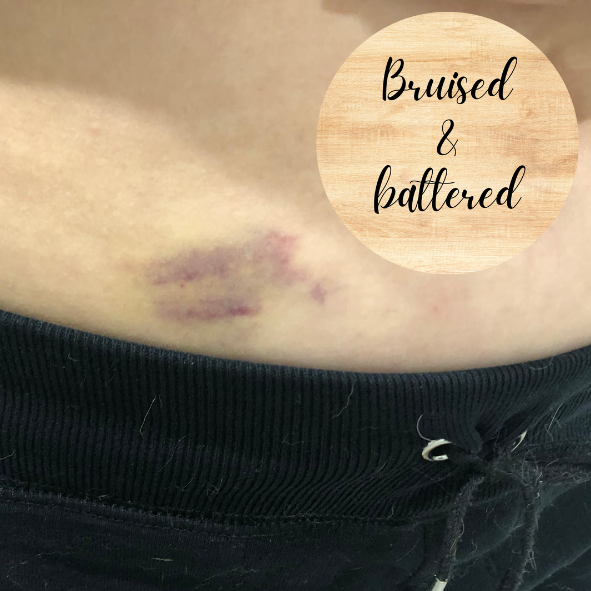 Bruised and battered.png