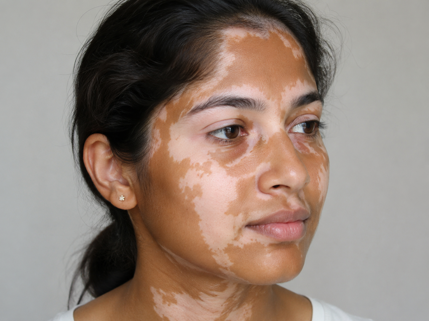 Vitiligo: Which Treatments Actually Help — and What to Be Cautious Of