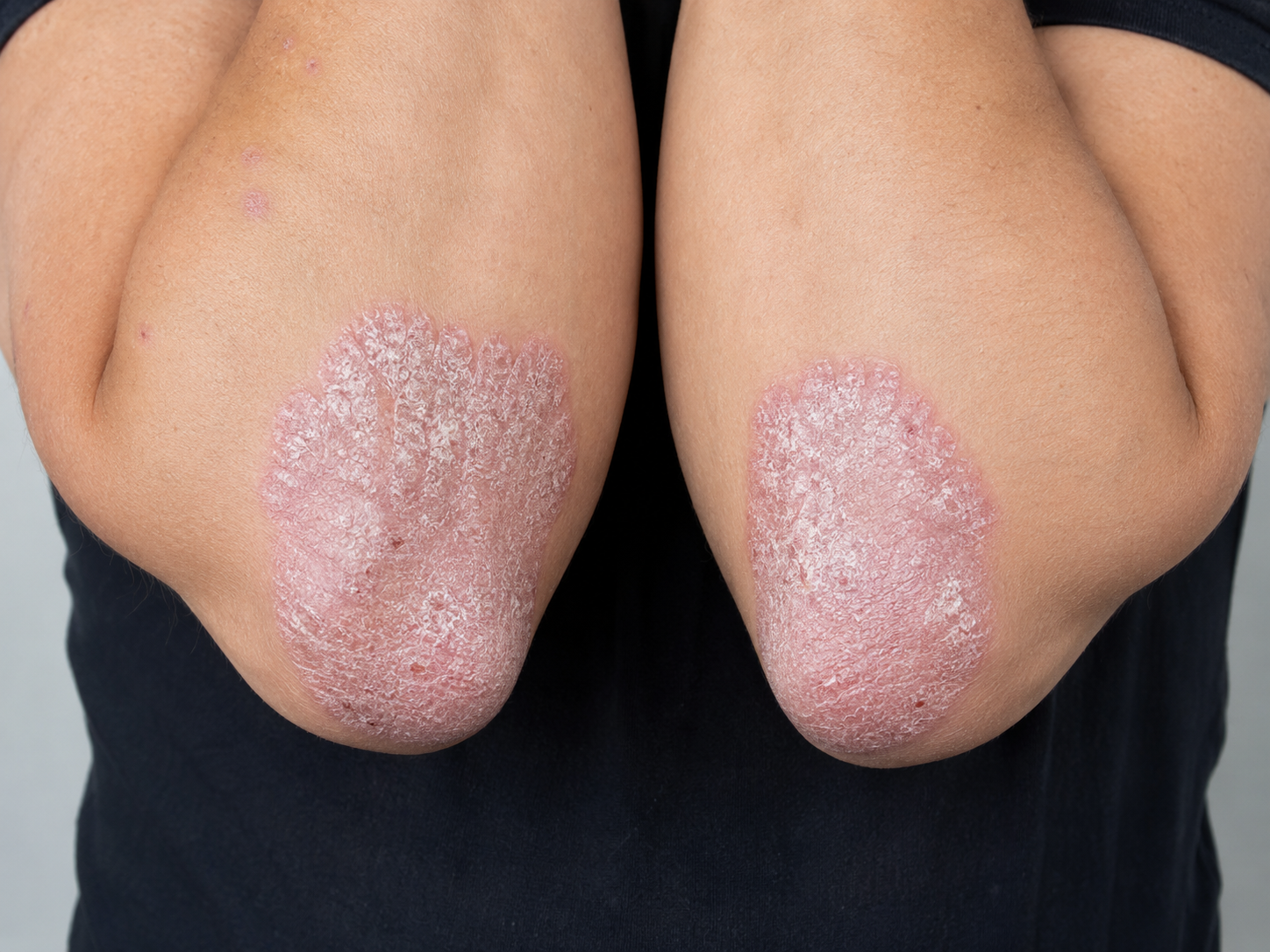 Psoriasis and Metabolic Syndrome: Why Psoriasis Is More Than Skin Deep
