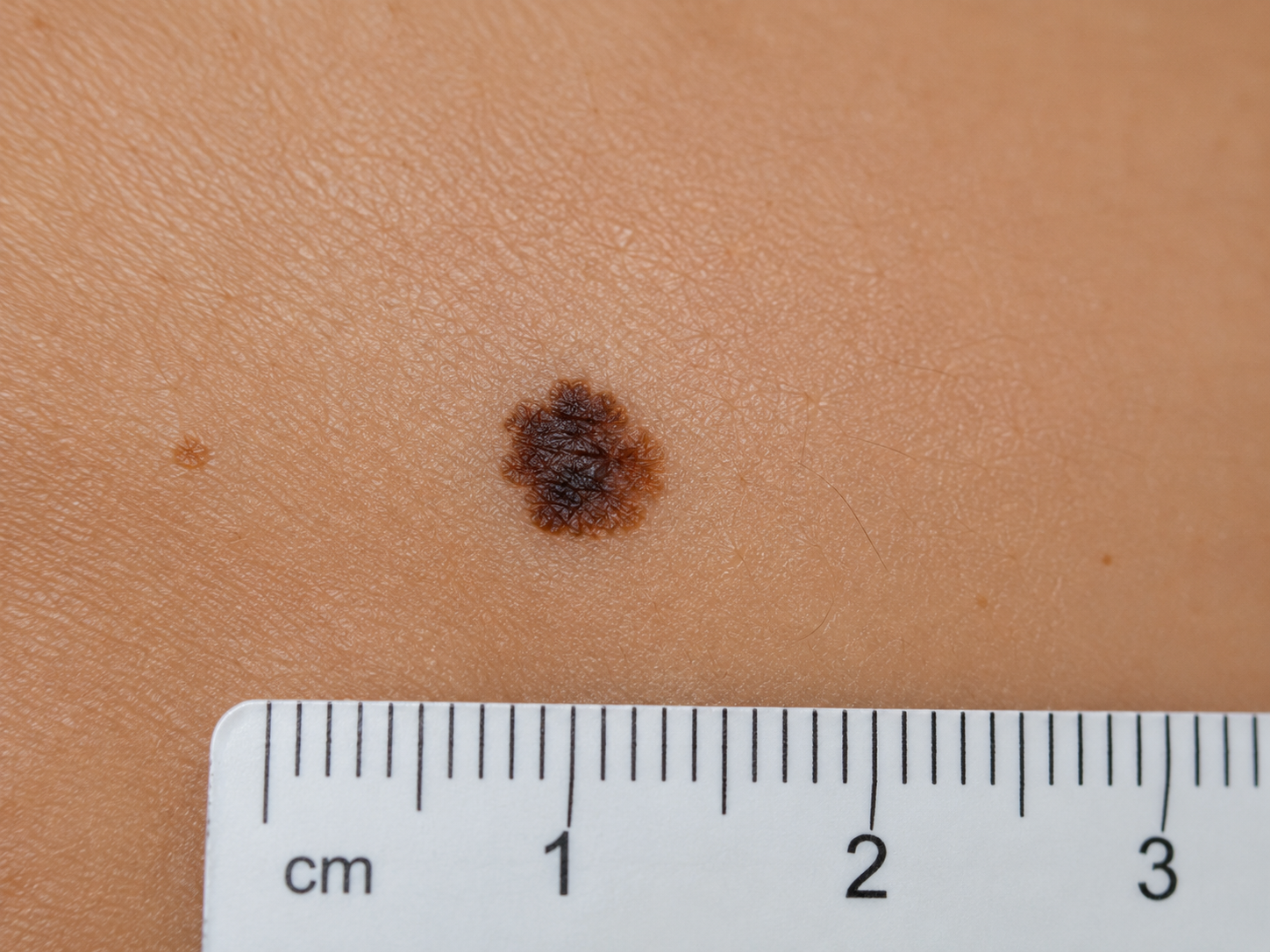 How Often Should You Have a Skin Cancer Check?