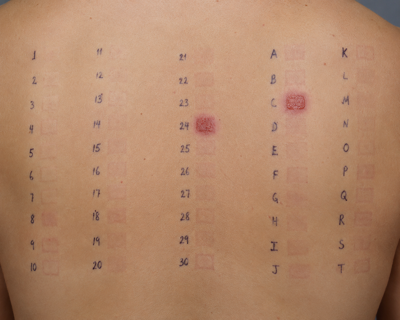 Back of person showing two positive patch test reactions.
