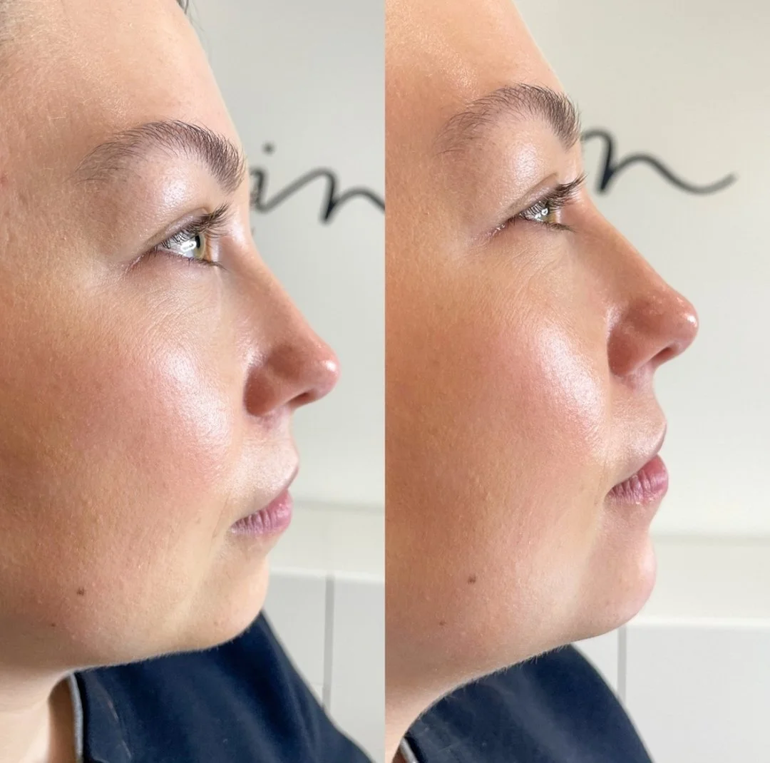Subtle 𝗖𝗵𝗶𝗻 adjustments with Dermal Fillers.jpg