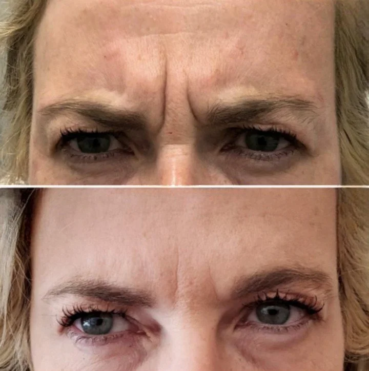 Frown Tox before and after treatment photo.jpg