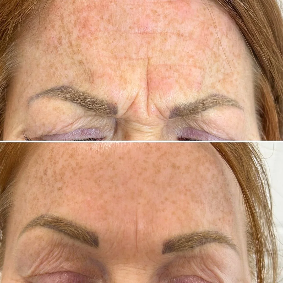 Frown Tox treatment using Botox.jpg