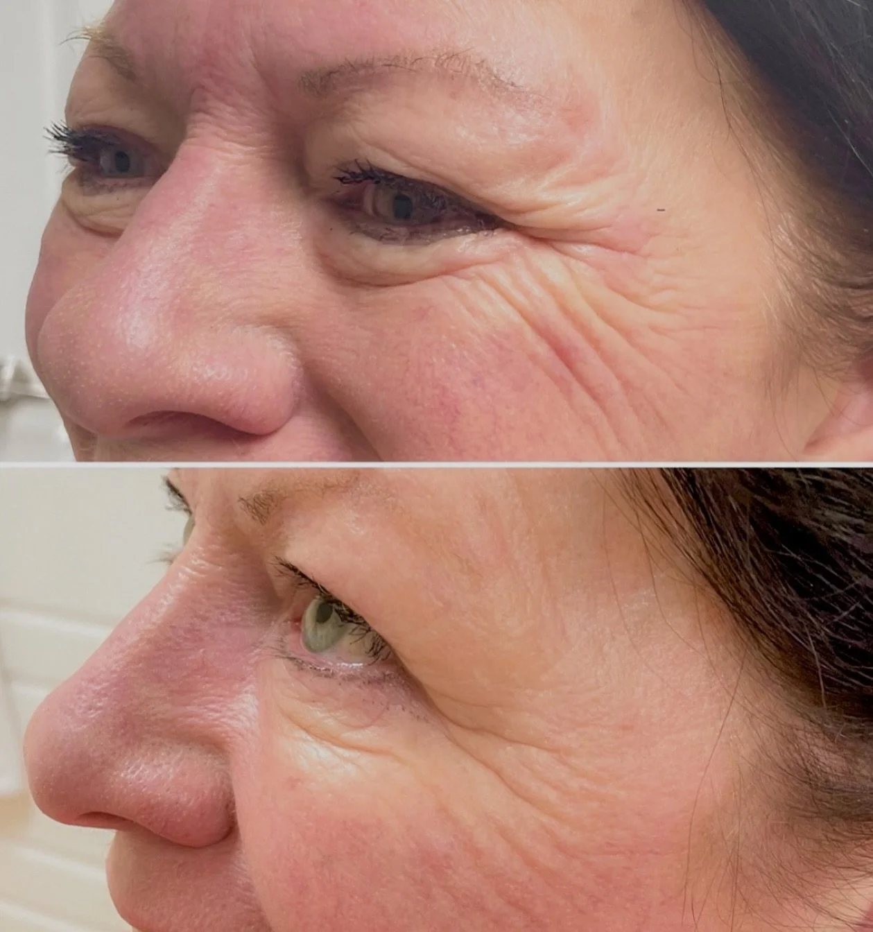 Botox before and after results.jpg