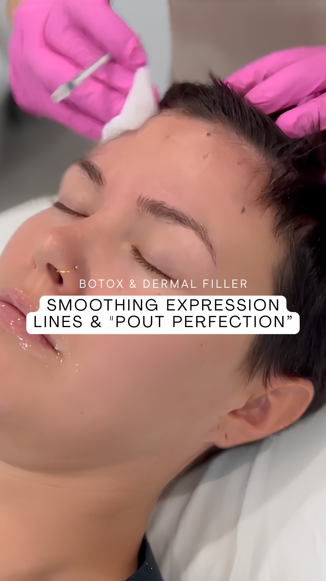 Video of natural lip filler and forehead Botox results by Dr. Kristen Read ND in Vernon and Lake Country, BC