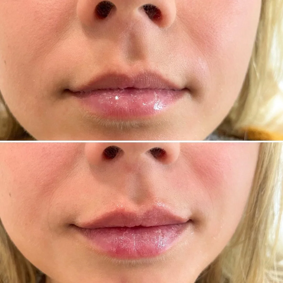 Lip Filler before and after results.jpg