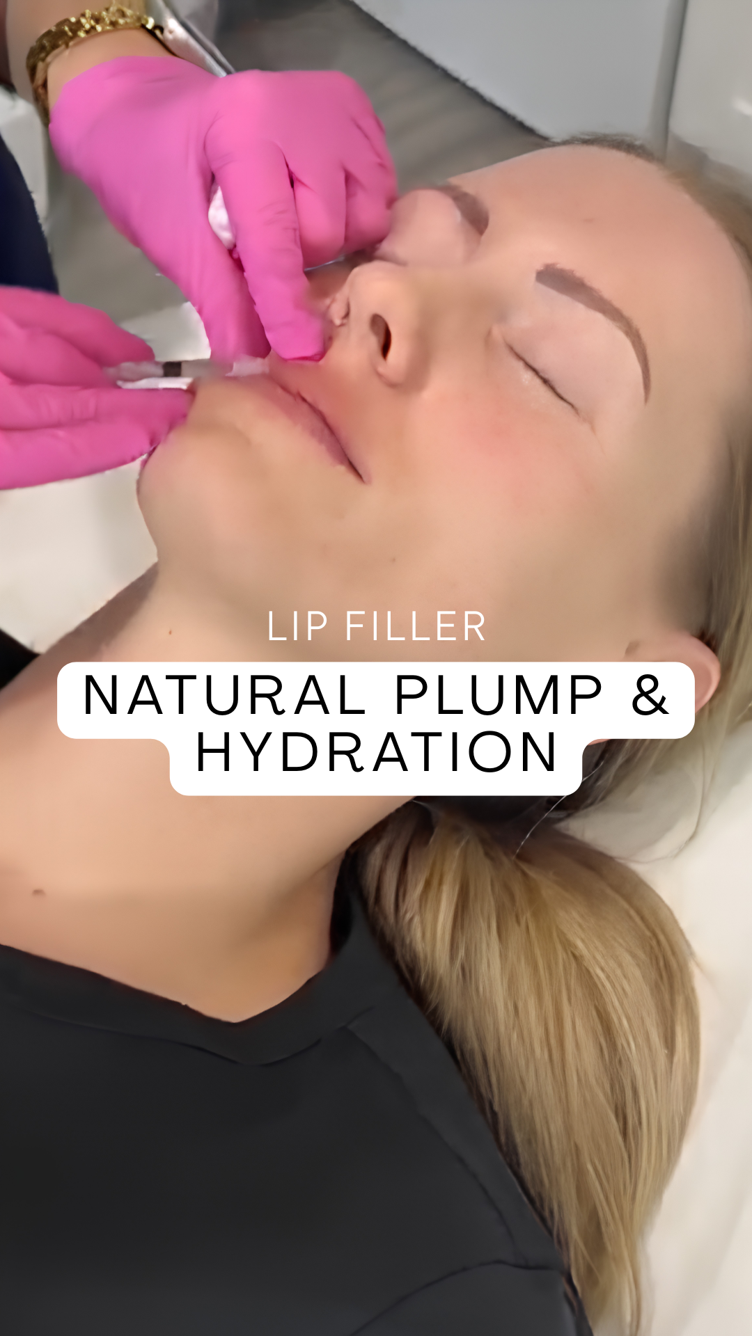 A Natural Plump and Hydration Lip Filler Treatment Video