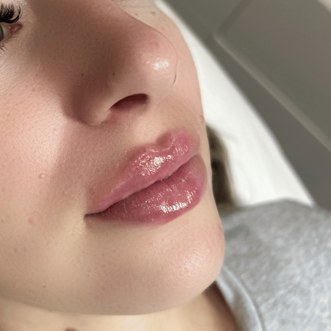 Natural Volume, Definition and Hydration of the Lips.png