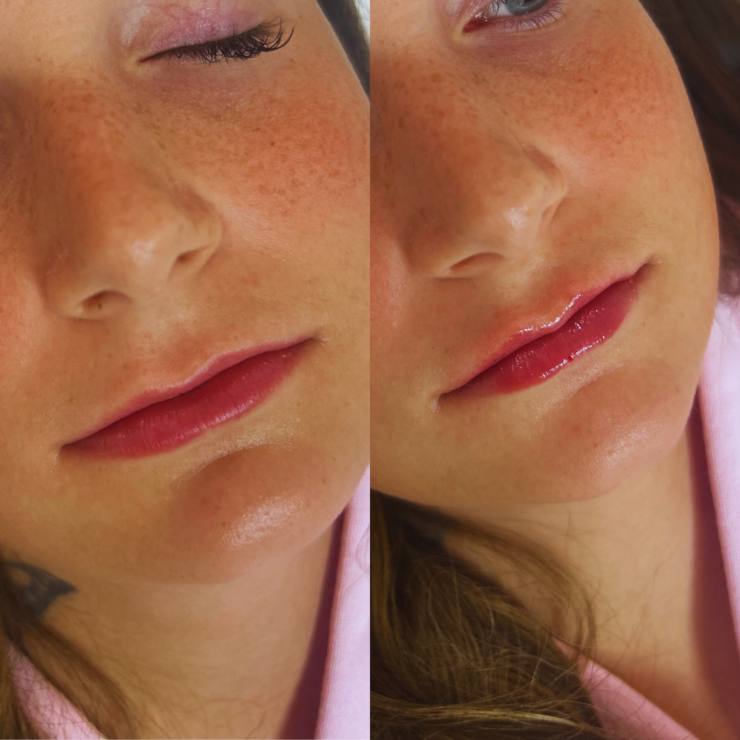 Before and After image for Natural Volumization & Cupid's Bow Definition of the lips.png