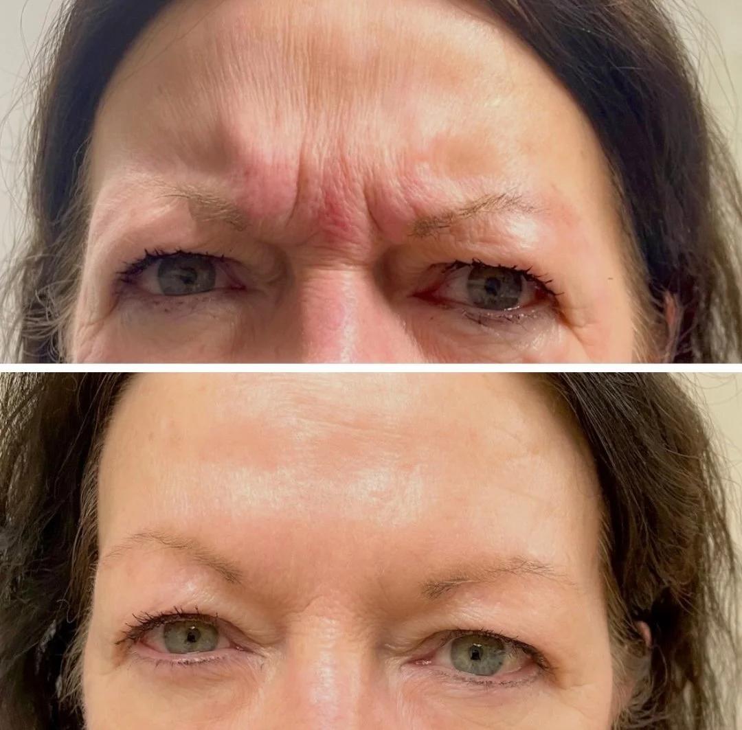 Botox before and after results.jpg