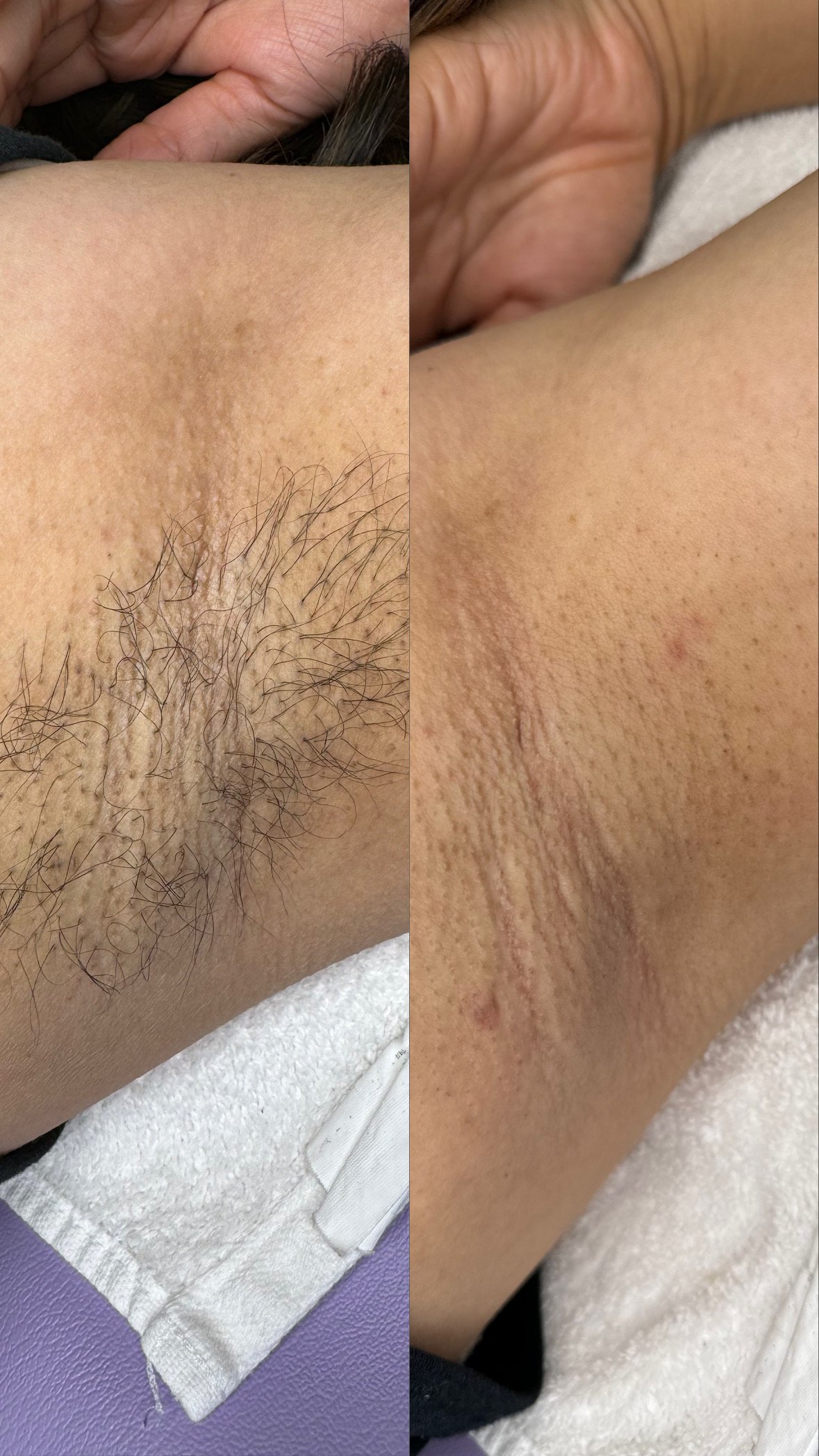 Underarm Sugaring