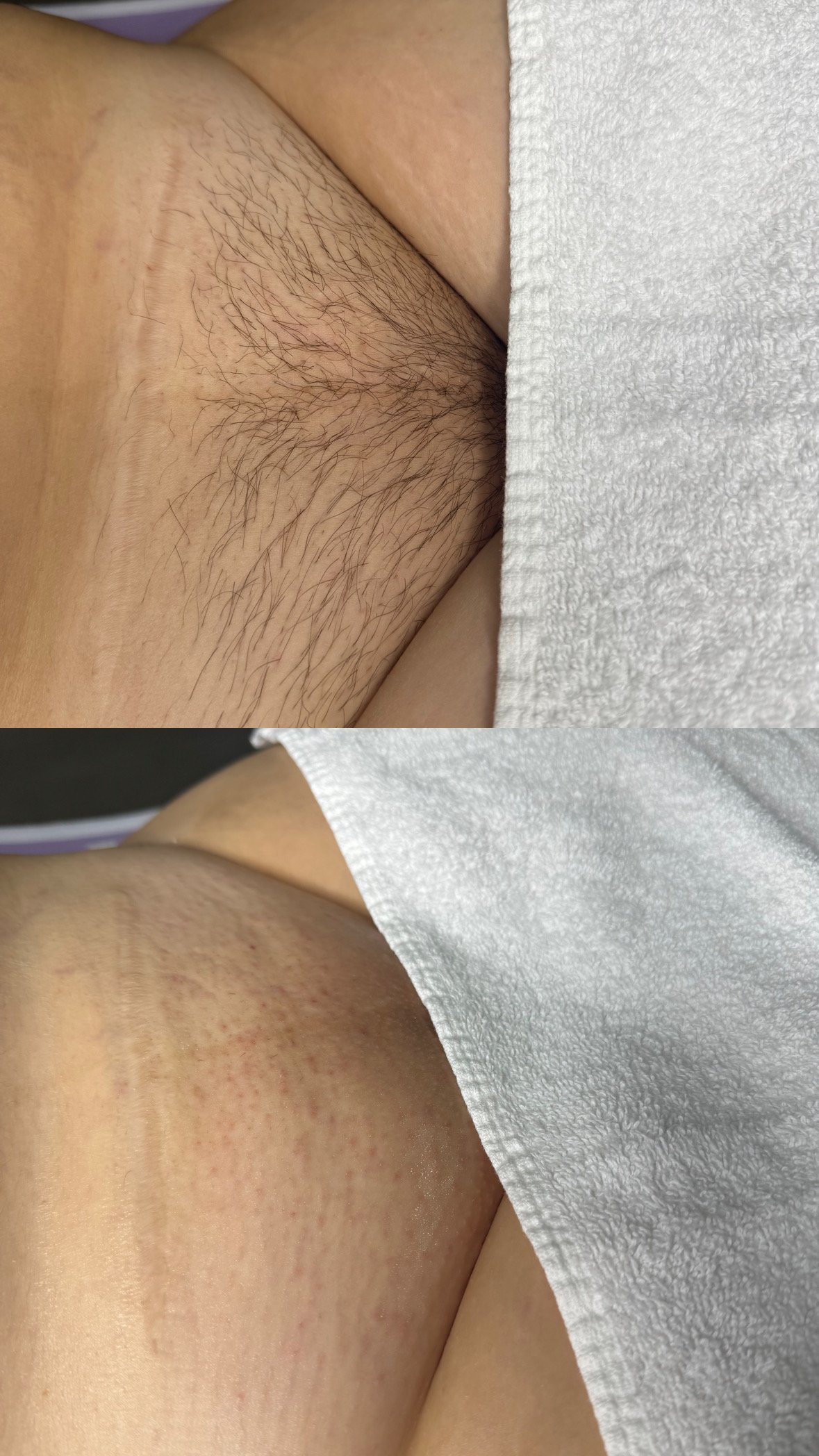 Brazilian Sugaring