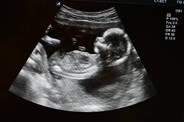 Why There Is No Middle Ground on Abortion
