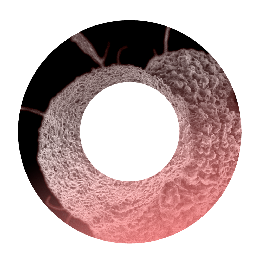 Close-up of human cancer cells under a microscope.