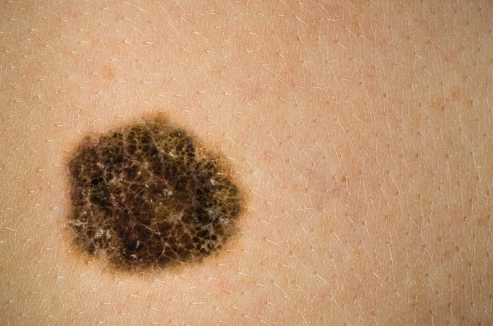 What's the relationship between melanoma and autoimmune diseases?