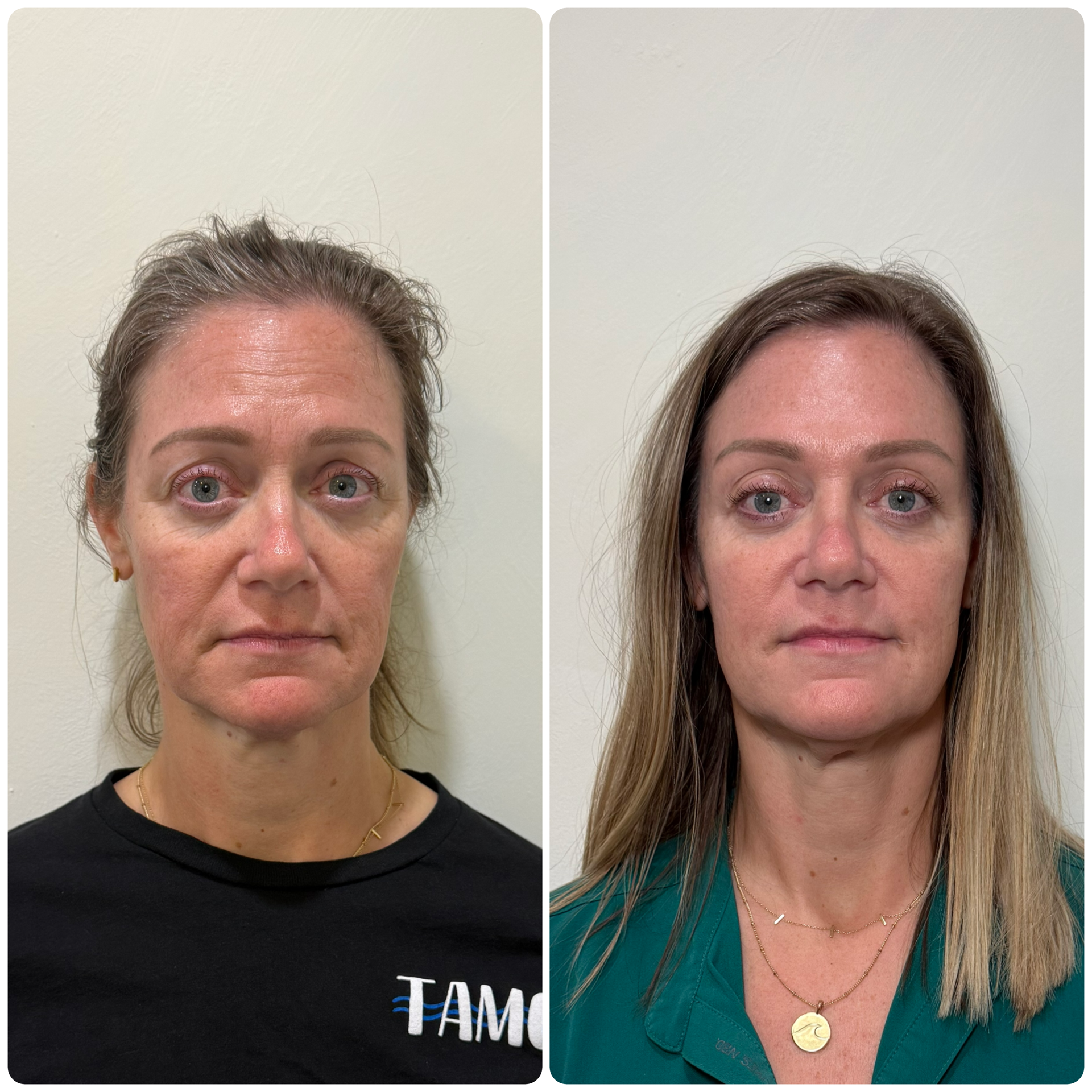 Before and after images of a woman showing facial improvements, with the left side showing a woman with more visible signs of aging and the right side showing the same woman with a more youthful appearance.