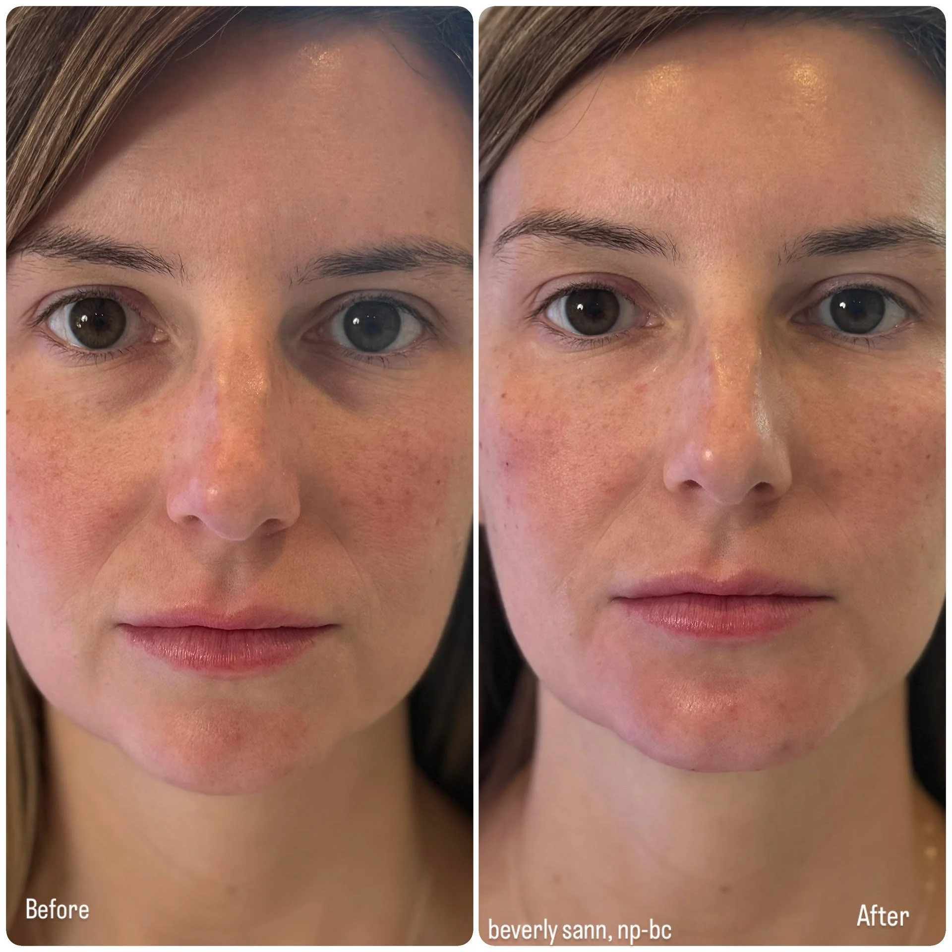 Close-up comparison image showing a person's face before and after a cosmetic treatment, focusing on the eye area, highlighting improved skin texture and appearance, and minimizing hallowing of the eyes