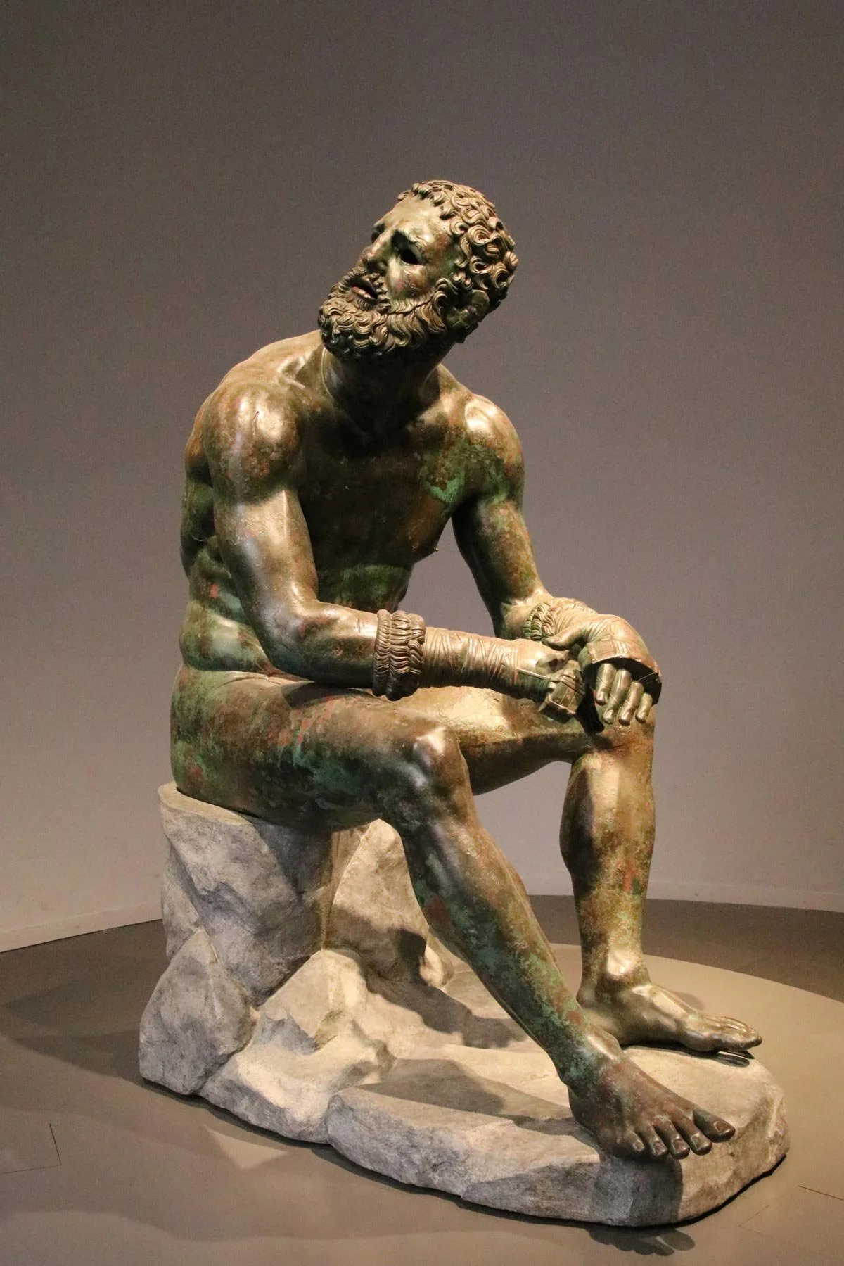Bronze Seated Boxer with battered features and wrapped hands, resting after a fight.