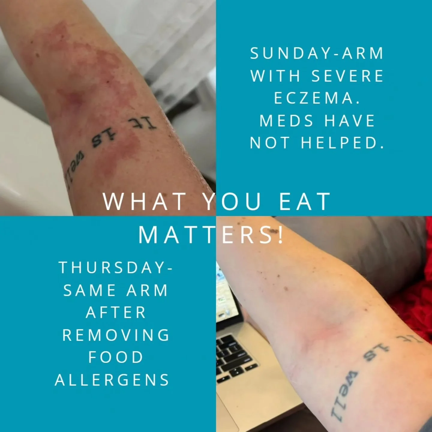 If you have any sort of chronic condition that you can't figure out the cause or your doctor hasn't looked into the cause, I highly recommend investigating what you eat. This person was tested several years ago. She has allergies to all grains, legum