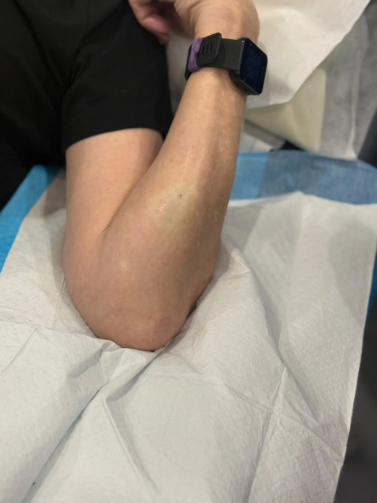 lipoma before.jpeg