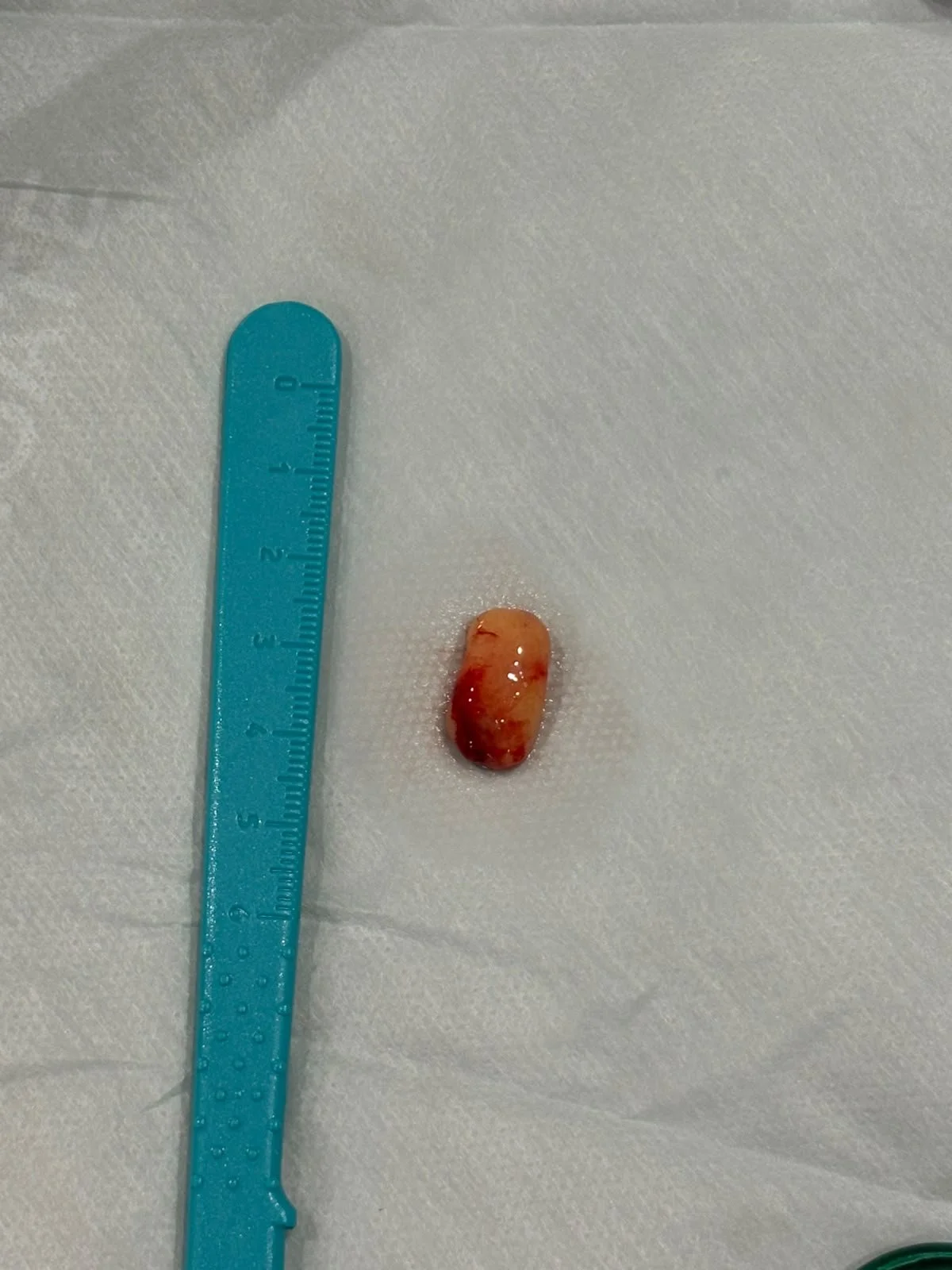 lipoma after.jpeg