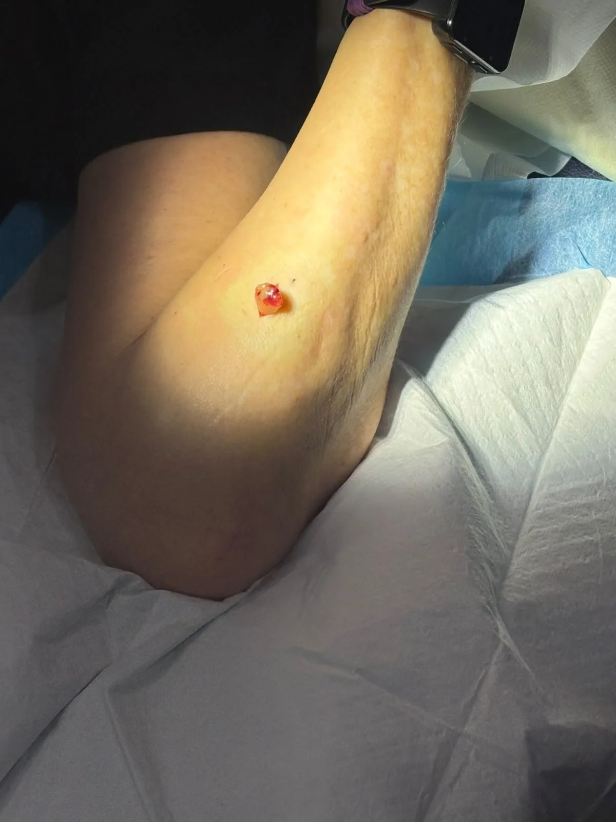 lipoma during.jpeg