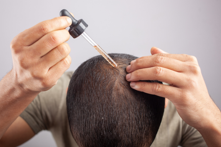 Compounding Pharmacy in Vienna, WV: Topical Minoxidil & Finasteride for Hair Loss