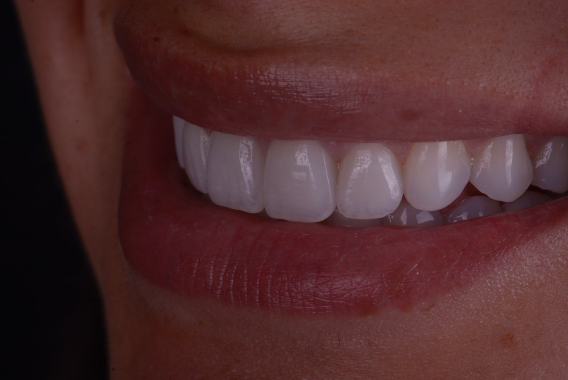 How Much Do Porcelain Veneers Cost in San Antonio?