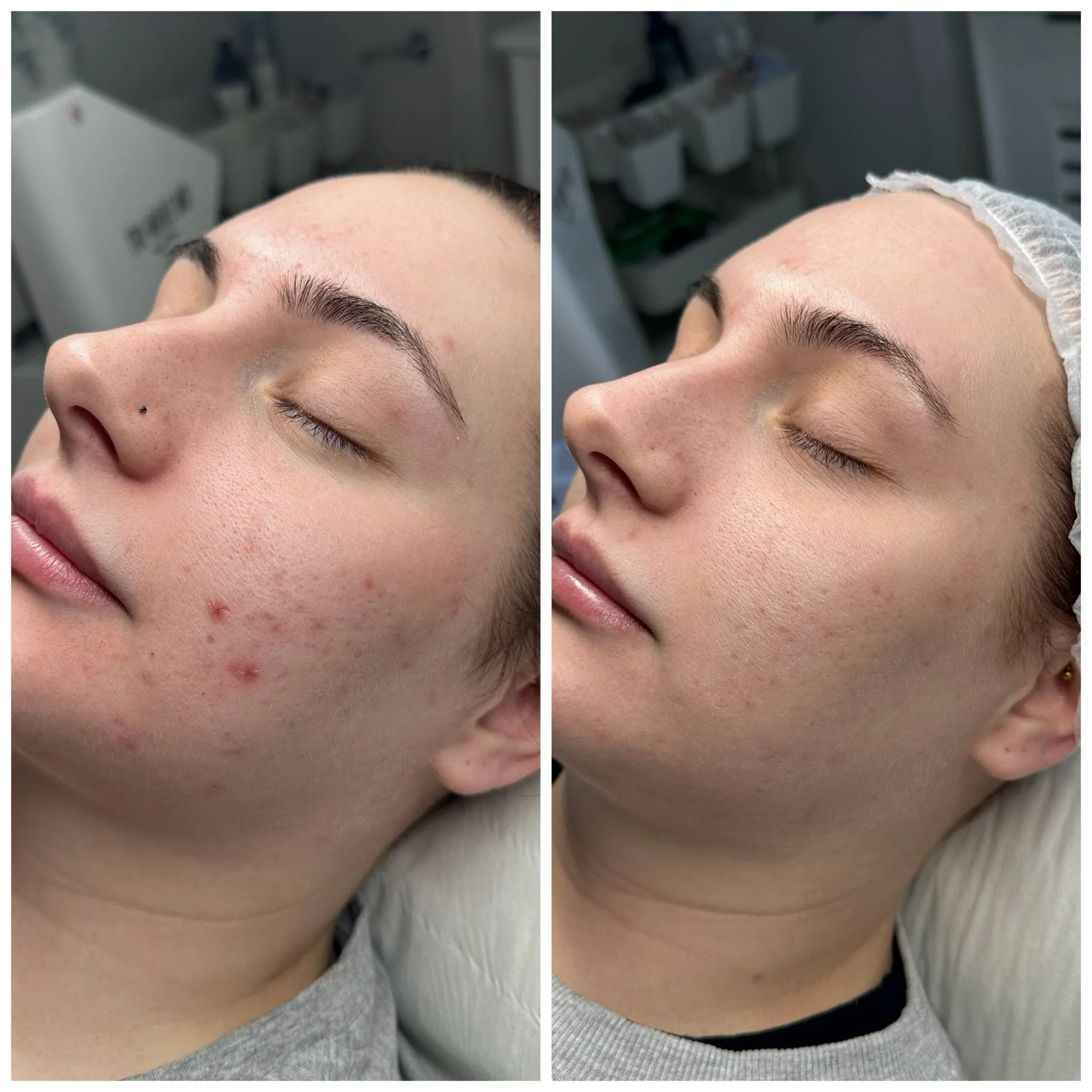 Less Blemishes. More Confidence..jpg