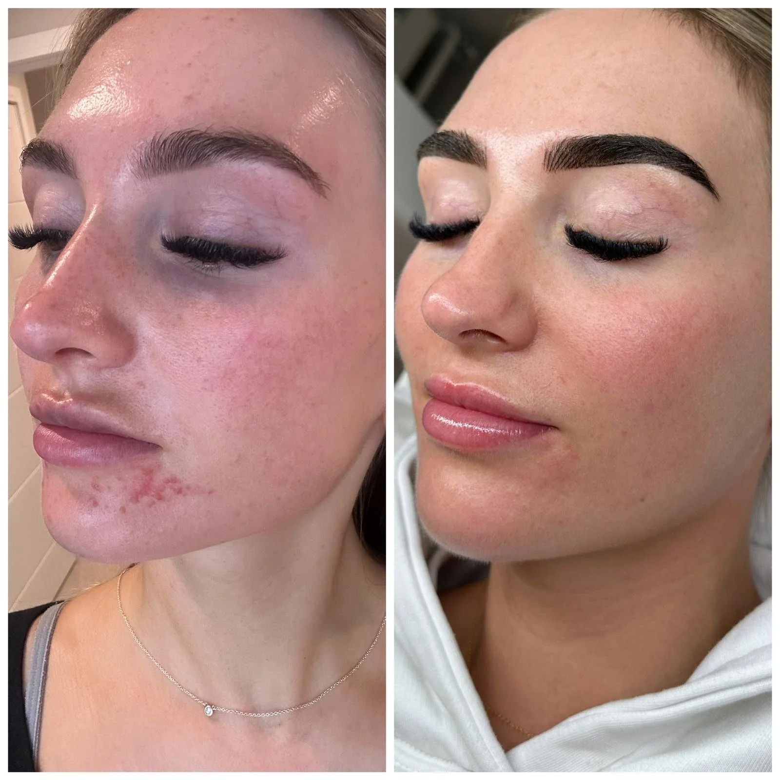 My Microneedling Hits Different.jpg