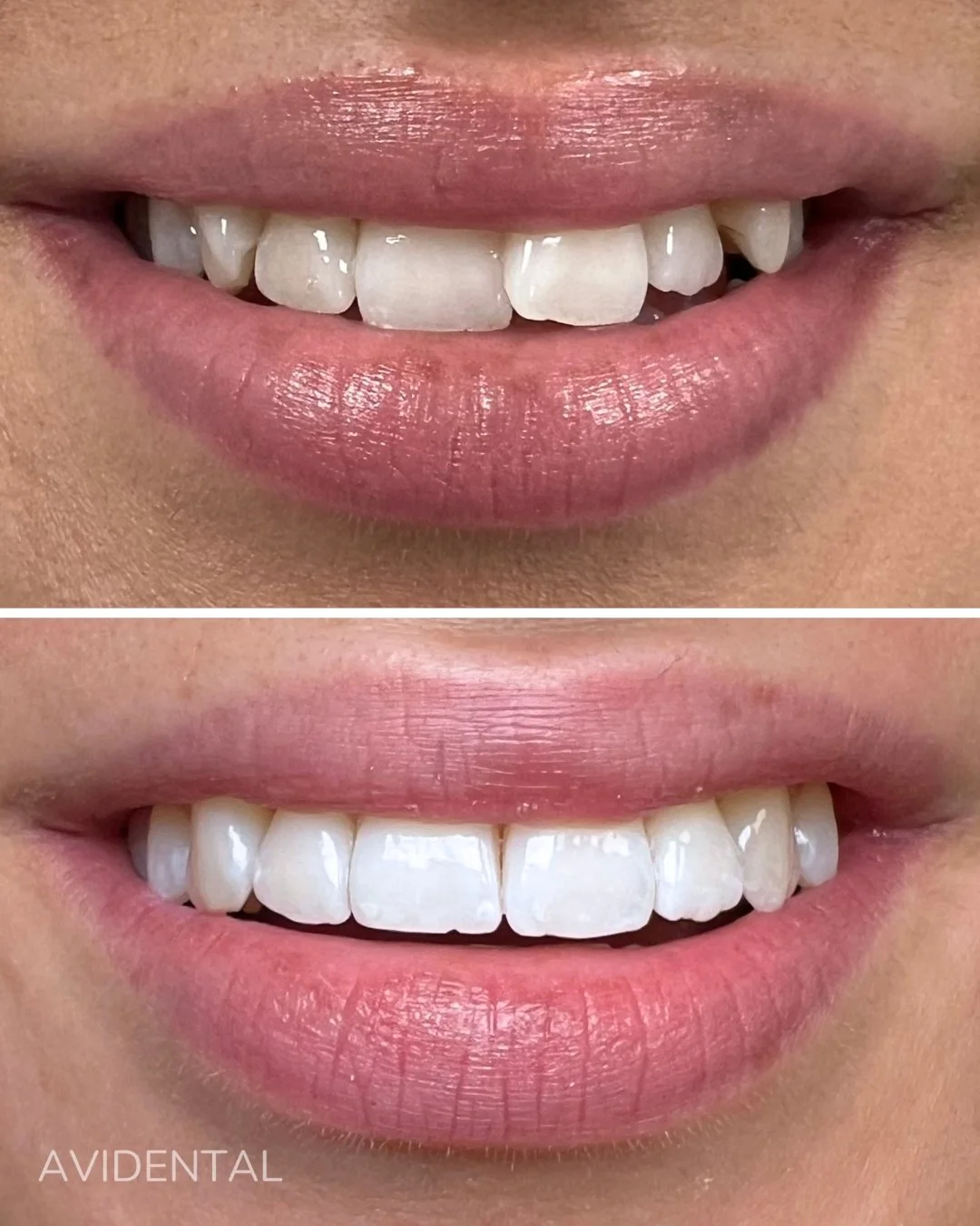 Elegans b&ouml;rjar med ett sj&auml;lvs&auml;kert leende ✨

Tandreglering med Invisalignbehandling 🤍

Boka din tid genom l&auml;nken i bio
Samaritv&auml;gen 12, Tumba📍
.
.
.
#tandl&auml;kare #tandv&aring;rd #t&auml;nder #tumba #avidental