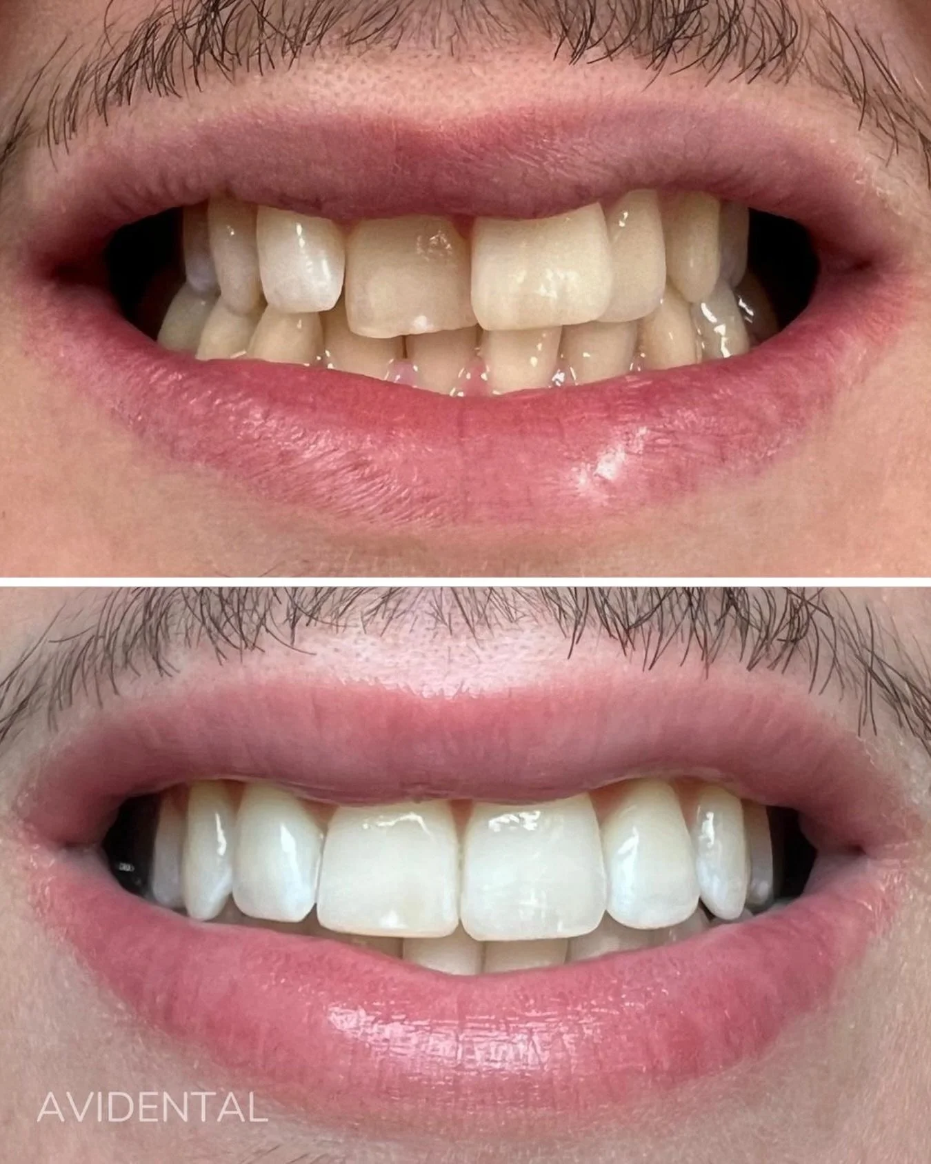 Invisalign och tandblekning🤍 

Vi hj&auml;lper dig att f&aring; ett leende du trivs med✨

Boka din tid genom l&auml;nken i bio eller ring oss p&aring; 08-883466.
Samaritv&auml;gen 12, Tumba📍
.
.
.
#tandl&auml;kare #tandv&aring;rd #t&auml;nder #tumb