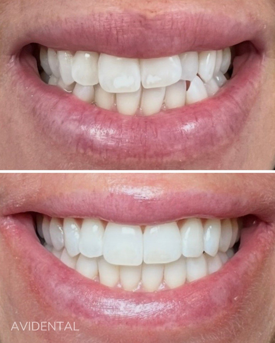 INVISALIGN - ICON - TANDBLEKNING🤍

Patienten kom till oss med &ouml;nskem&aring;l om rakare och vitare t&auml;nder samt att f&aring; bort de vita fl&auml;ckarna p&aring; framt&auml;nderna.

Med en kombination av Invisalign, ICON-behandling och tandb