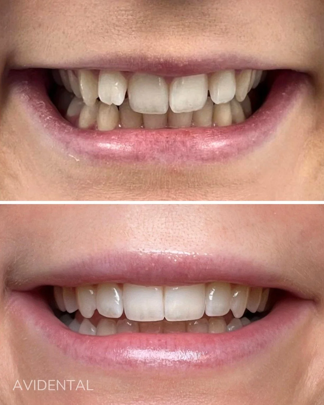 Resultatet efter en invisalign behandling🤍 

Naturligt och sj&auml;lvs&auml;kert✨

Boka din tid genom l&auml;nken i bio eller ring oss p&aring; 08-883466.
Samaritv&auml;gen 12, Tumba📍
.
.
.
#tandl&auml;kare #tandv&aring;rd #t&auml;nder #tumba #avid