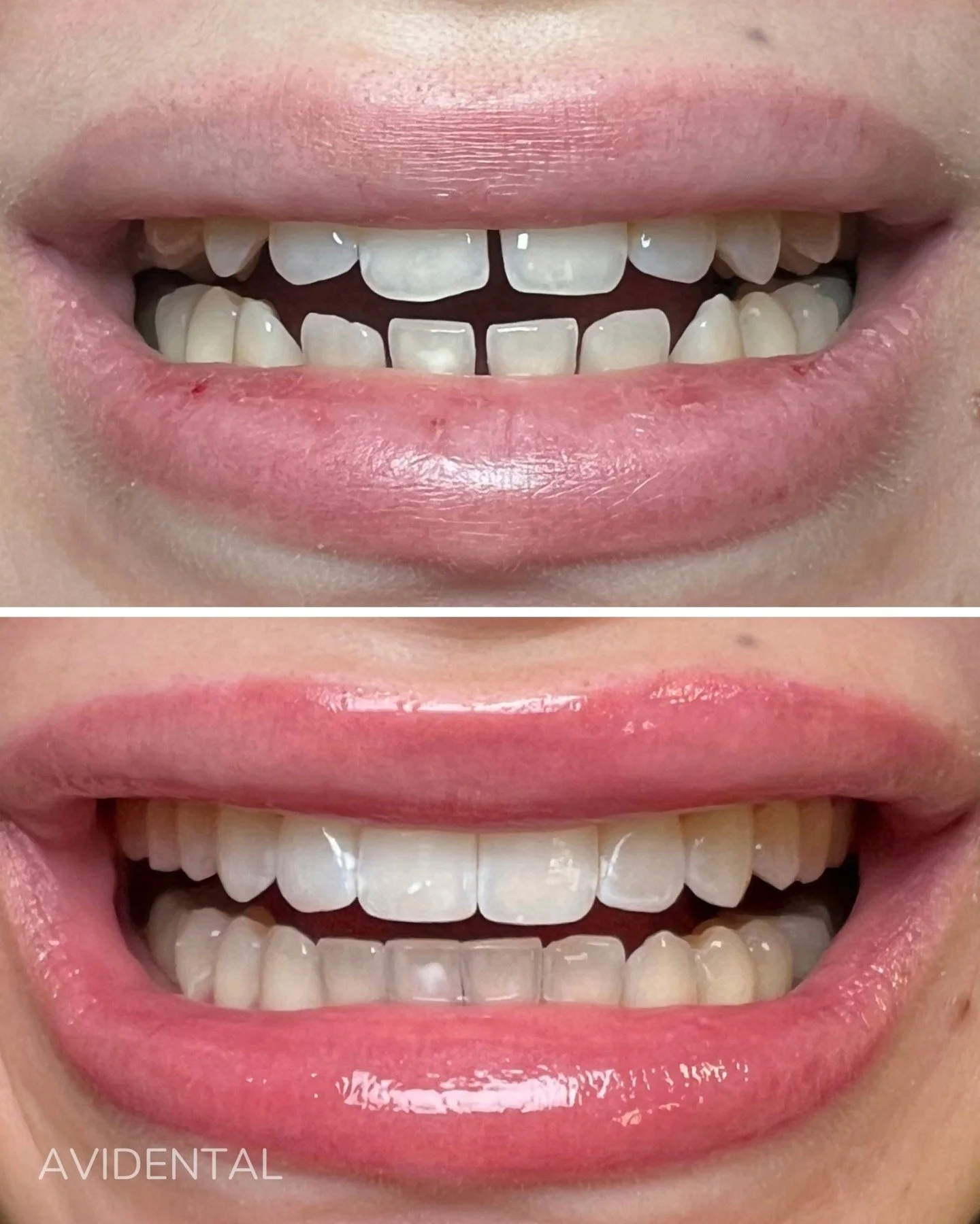 INVISALIGN🤍

Med Invisalign kan du f&aring; ett leende du trivs med✨

Boka din tid genom l&auml;nken i bio eller ring oss p&aring; 08-883466.
Samaritv&auml;gen 12, Tumba📍
.
.
.
#tandl&auml;kare #tandv&aring;rd #t&auml;nder #tumba #avidental