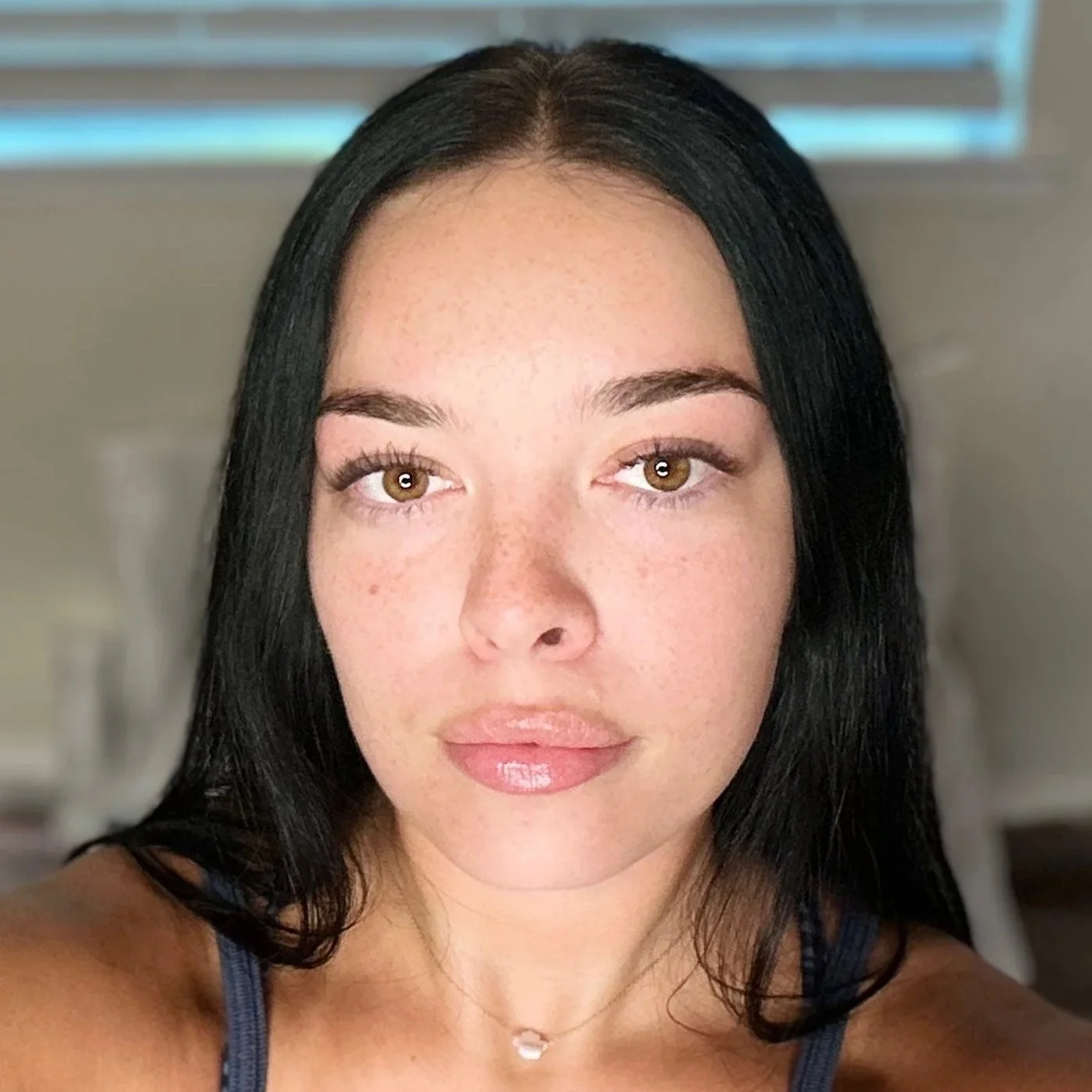 After Daxxify® forehead & 11’s