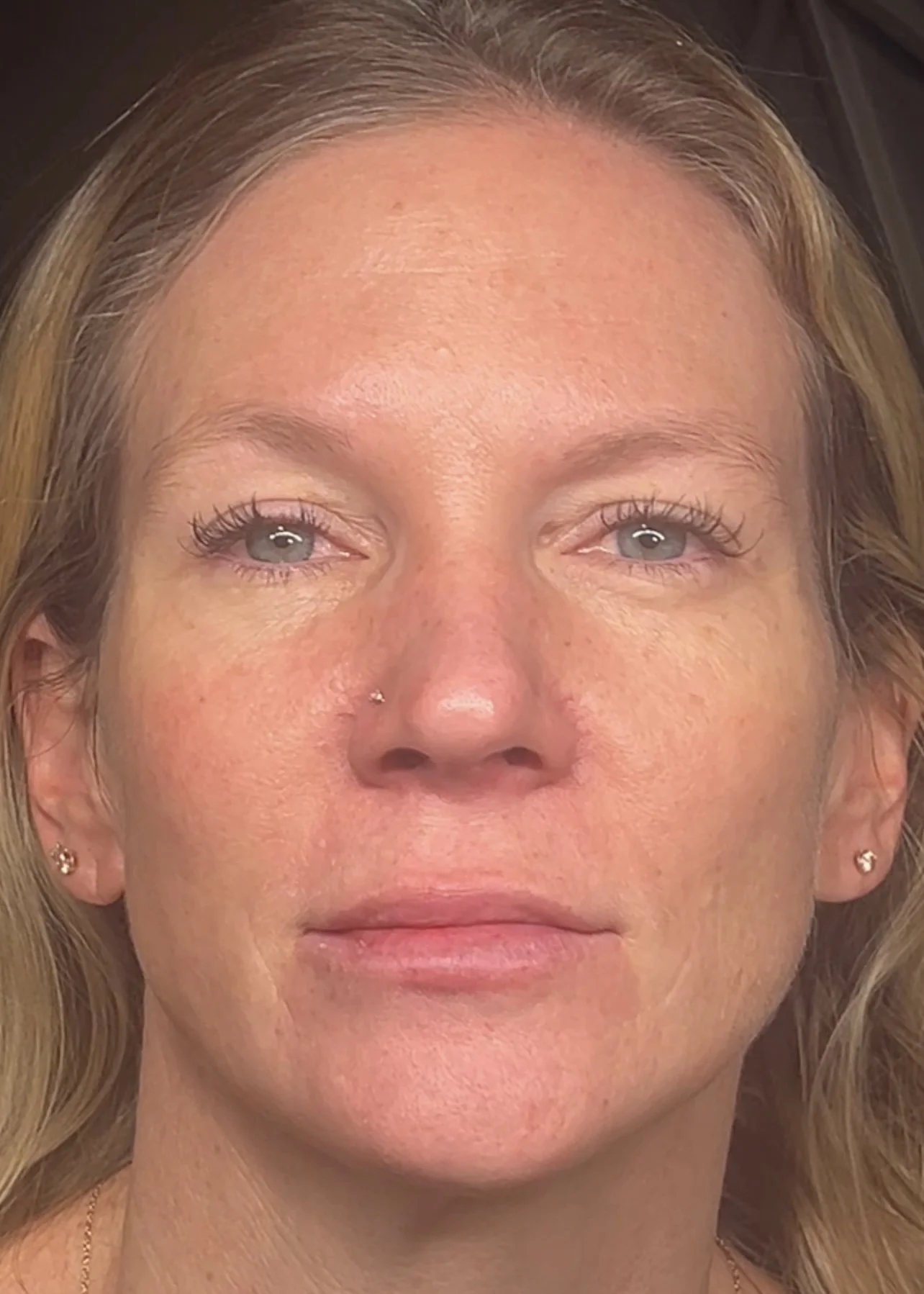 After 2 rounds of Daxxify + dissolved/new lip filler