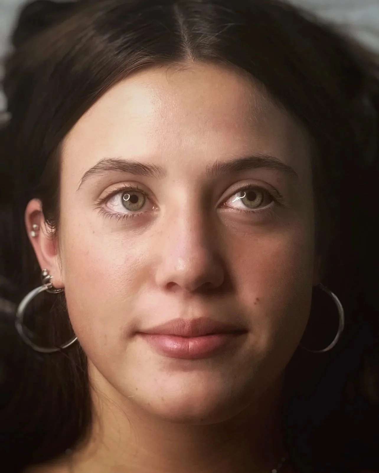 After Xeomin® lip flip & masseters