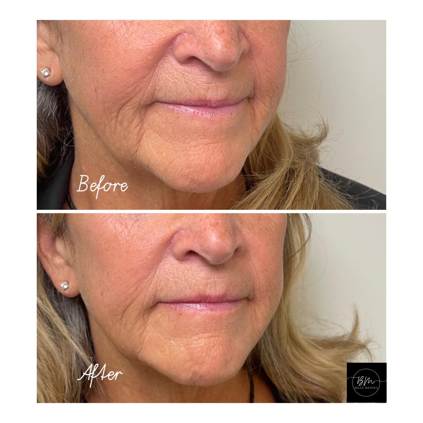Say goodbye to unwanted shadows around the mouth 👊

Using dermal filler, we softened the lines that extend from the corners of the mouth toward the chin&mdash;commonly known as marionette lines. Not only was I able to target this clients main concer