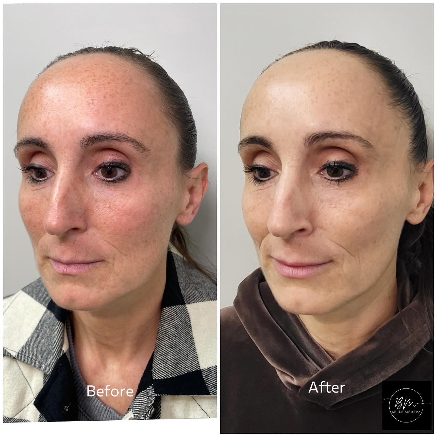In love with this beautiful micro-needling facial result!

This client has had 1 treatment so far between these before and afters. It&rsquo;s a favourite treatment for a good reason!
Here we can see quick and noticeable improvement to pigmentation, f