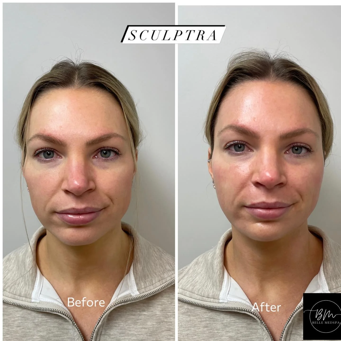 Biostimulator (Sculptra) Before + After 

A beautiful start to this client&rsquo;s collagen journey!

For this treatment, I focused on restoring contour and youthful volume to the cheeks, while also placing Sculptra in the temples, nasolabial folds, 