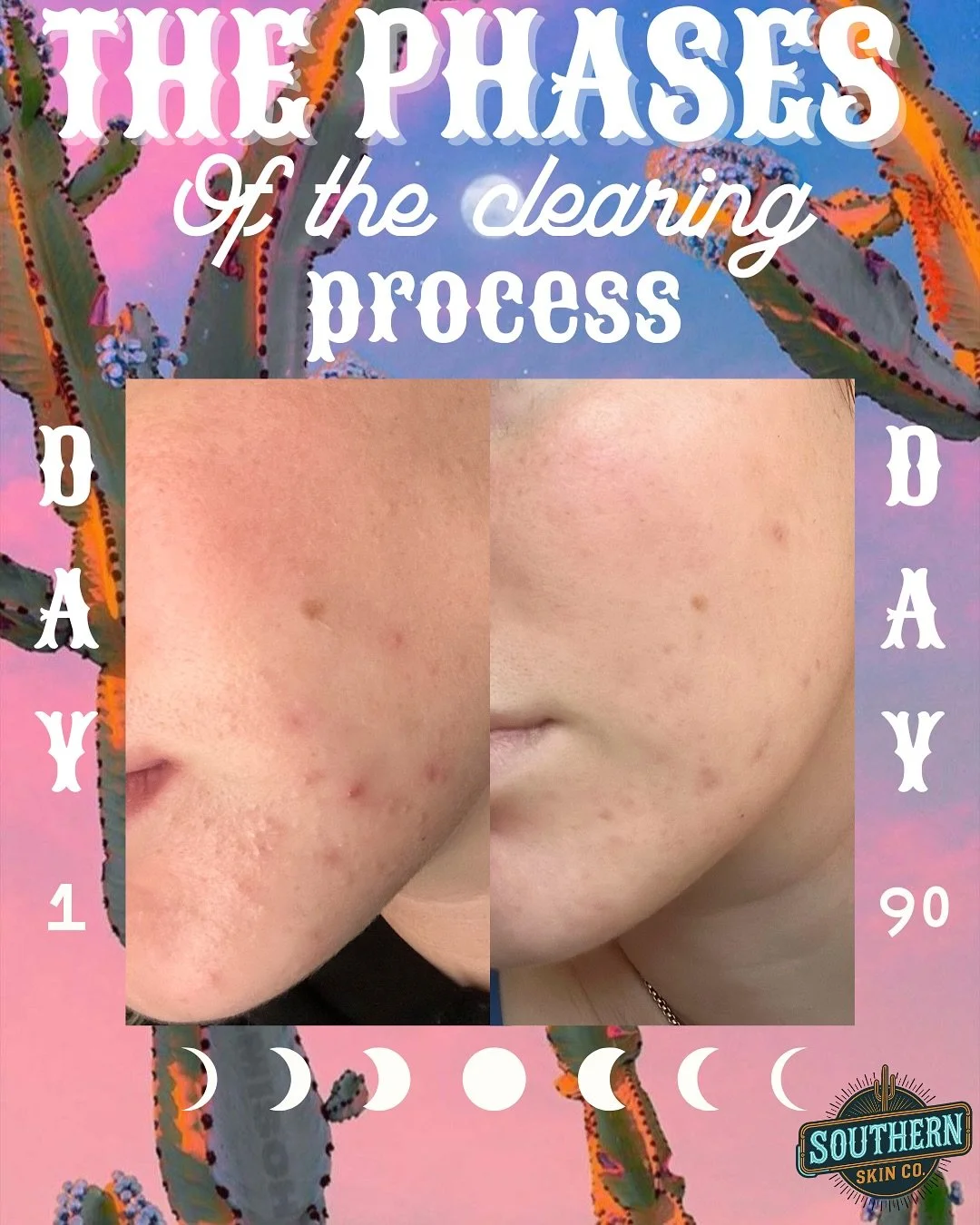 This is my very 1st fully clear virtual client, near and dear to my heart🫶🏻

🌙 We got her skin clear, fully virtual, no treatments, just a custom skincare regimen, education, nutrition guidance &amp; check ins!

🌙 you don&rsquo;t have to be an in