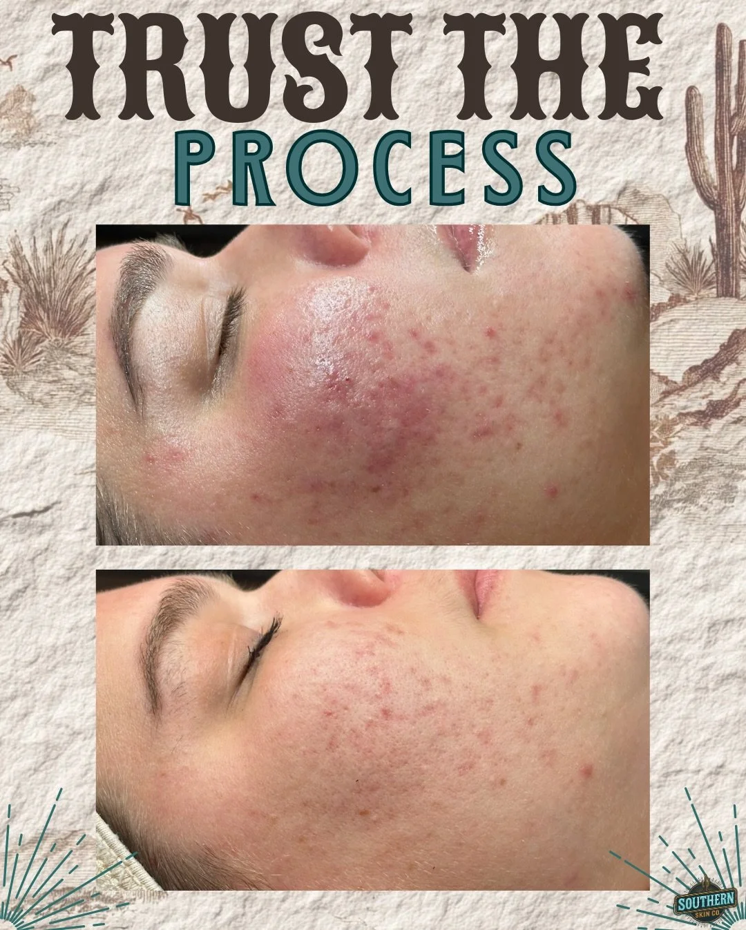 Proof that consistency + a customized plan works. ✨🤠

This acne transformation didn&rsquo;t happen overnight&mdash;it happened with commitment, guidance, and Acne Bootcamp. 

Ready to be my next before &amp; after?
👉 DM &ldquo;BOOTCAMP&rdquo; to ge