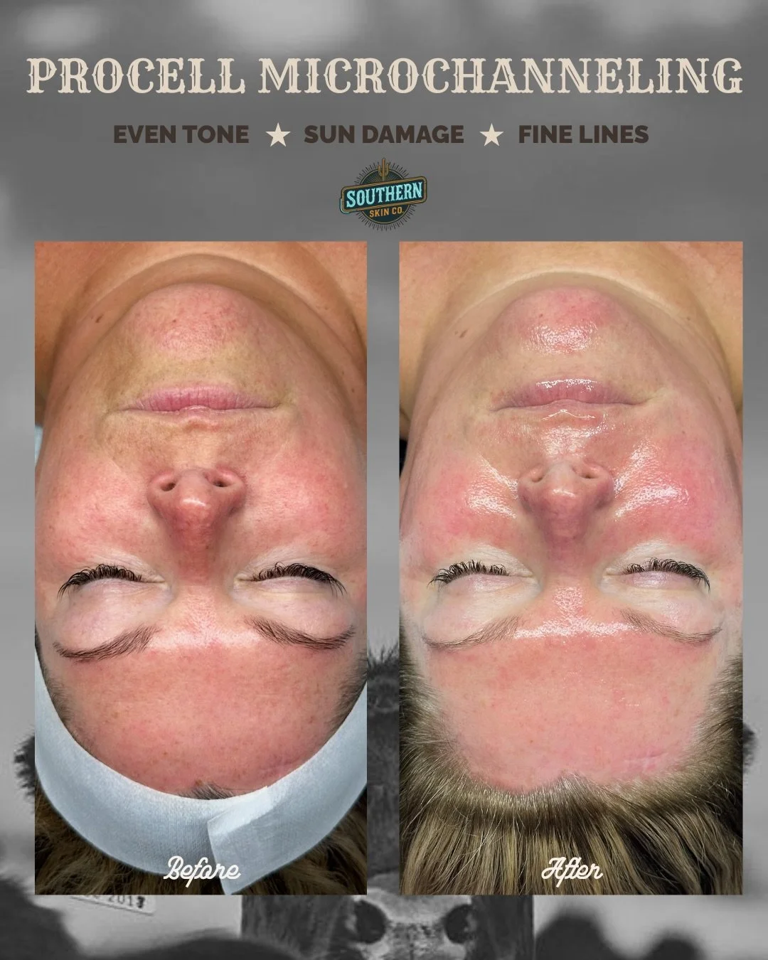 THE ANTI-AGING TREATMENT of 2026

⭐️Procell Microchanneling enhances cellular activity by creating thousands of microchannels. Each channel stimulates the skin&rsquo;s natural renewal process, initiating new collagen formation

⭐️Microchanneling trea