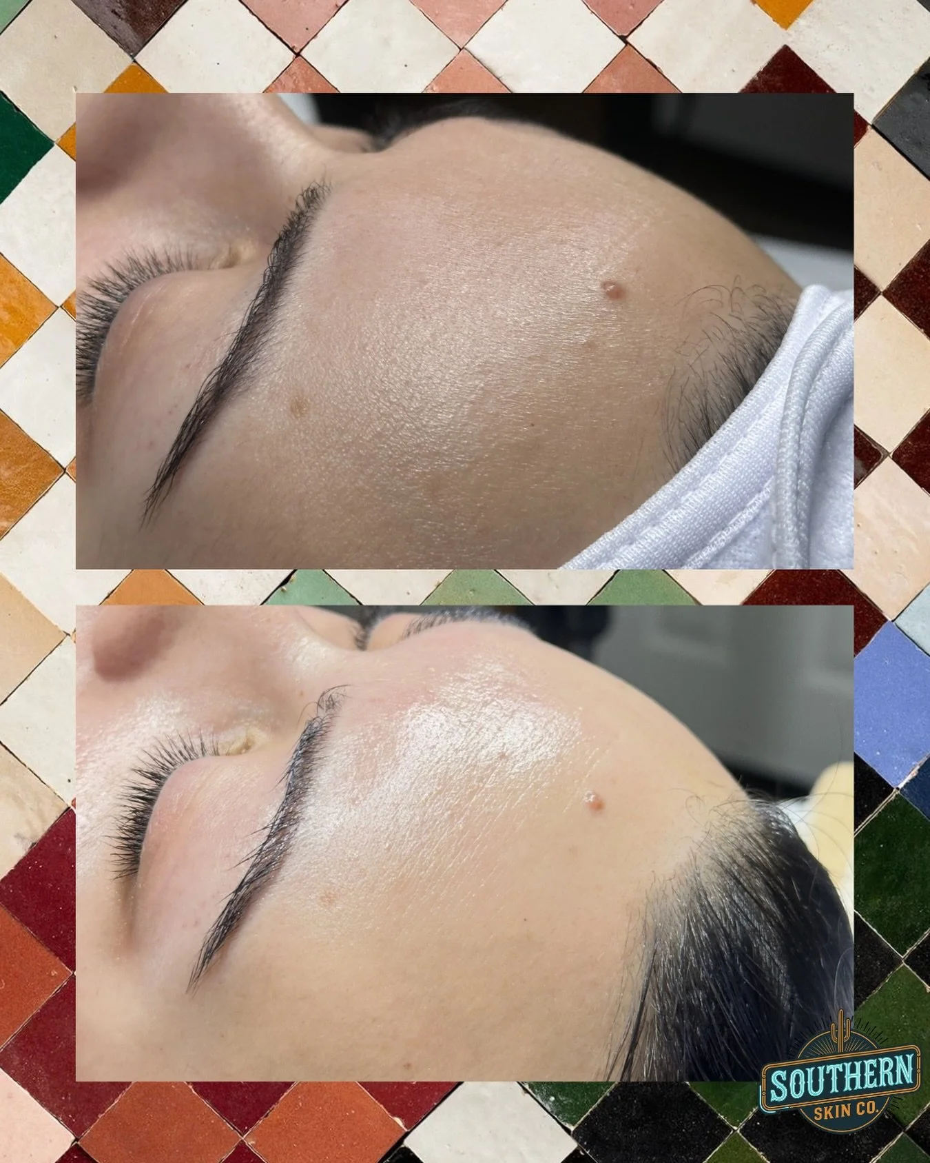 If your skin looks dull...this might be why✨

What you're seeing in this before and after is the exfoliation technique called dermaplaning, which is a professional removal of all the buildup on the surface! 

Dermaplaning works by:
✨ gently removing 